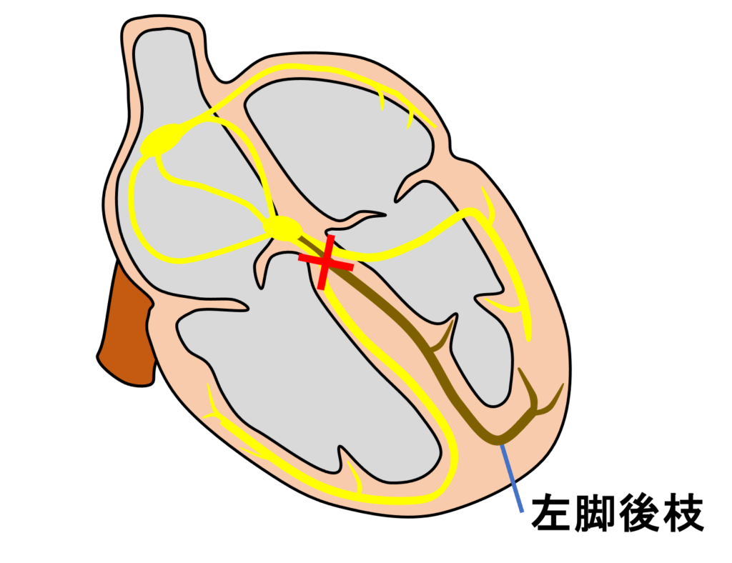 左脚後枝ブロック(left posterior fascicular block：LPFB)