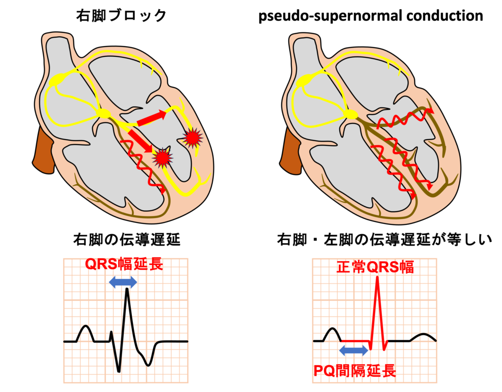 pseudo‐supernormal conduction