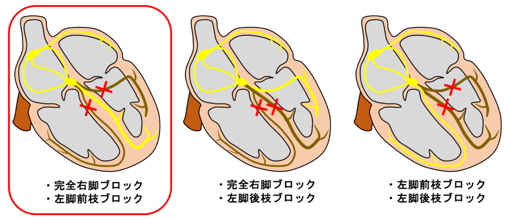 ２枝ブロック(bifascicular block)