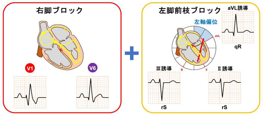 ２枝ブロック(bifascicular block)