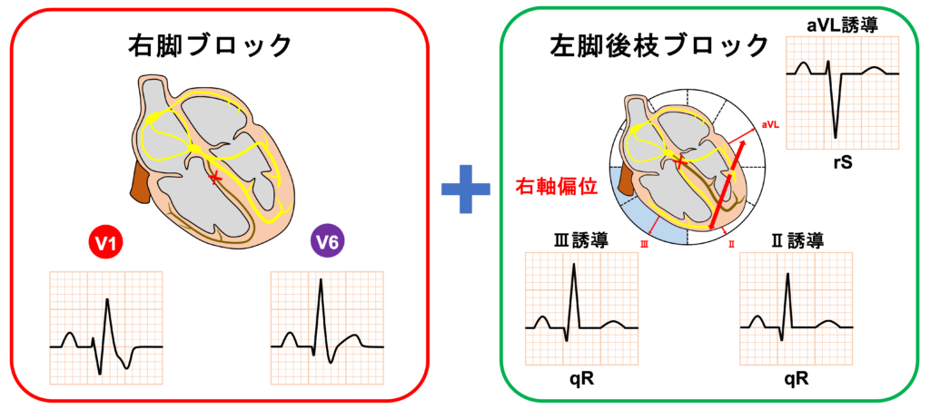 ２枝ブロック(bifascicular block)