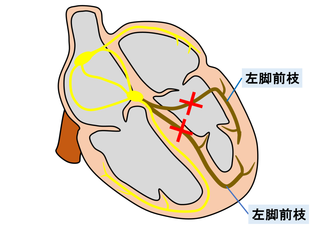 ２枝ブロック(bifascicular block)