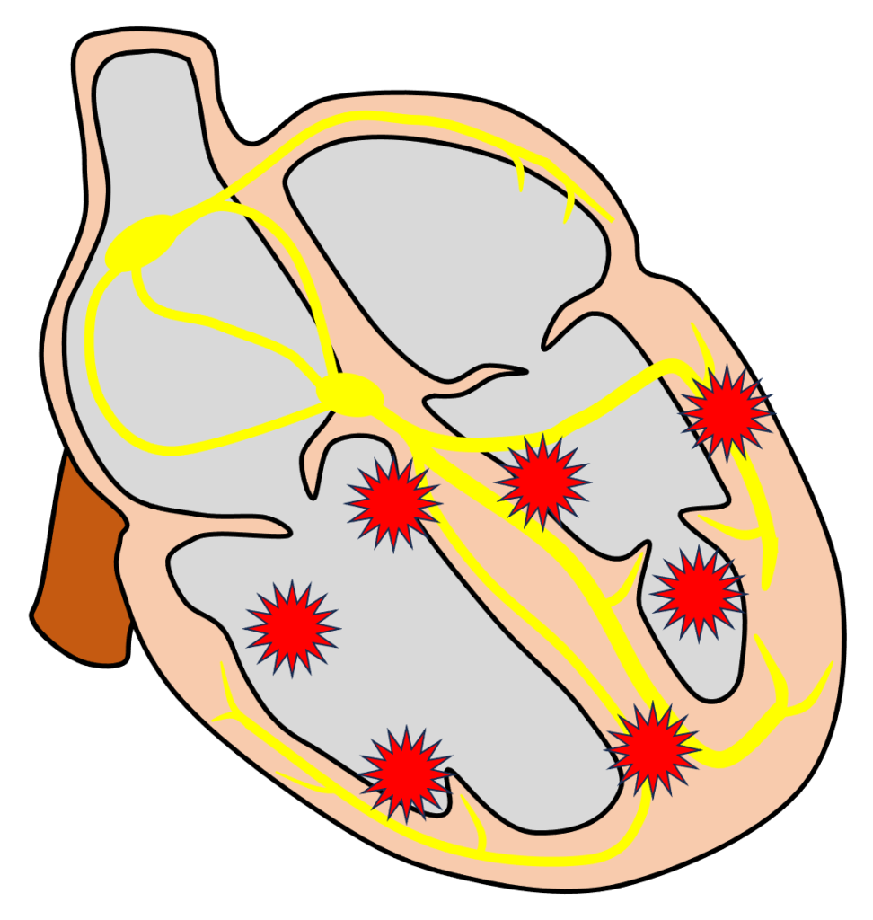 心室細動(Ventricular fibrillation)