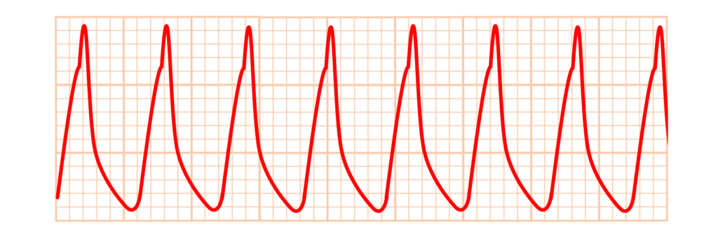 心室頻拍(Ventricular Tachycardia)