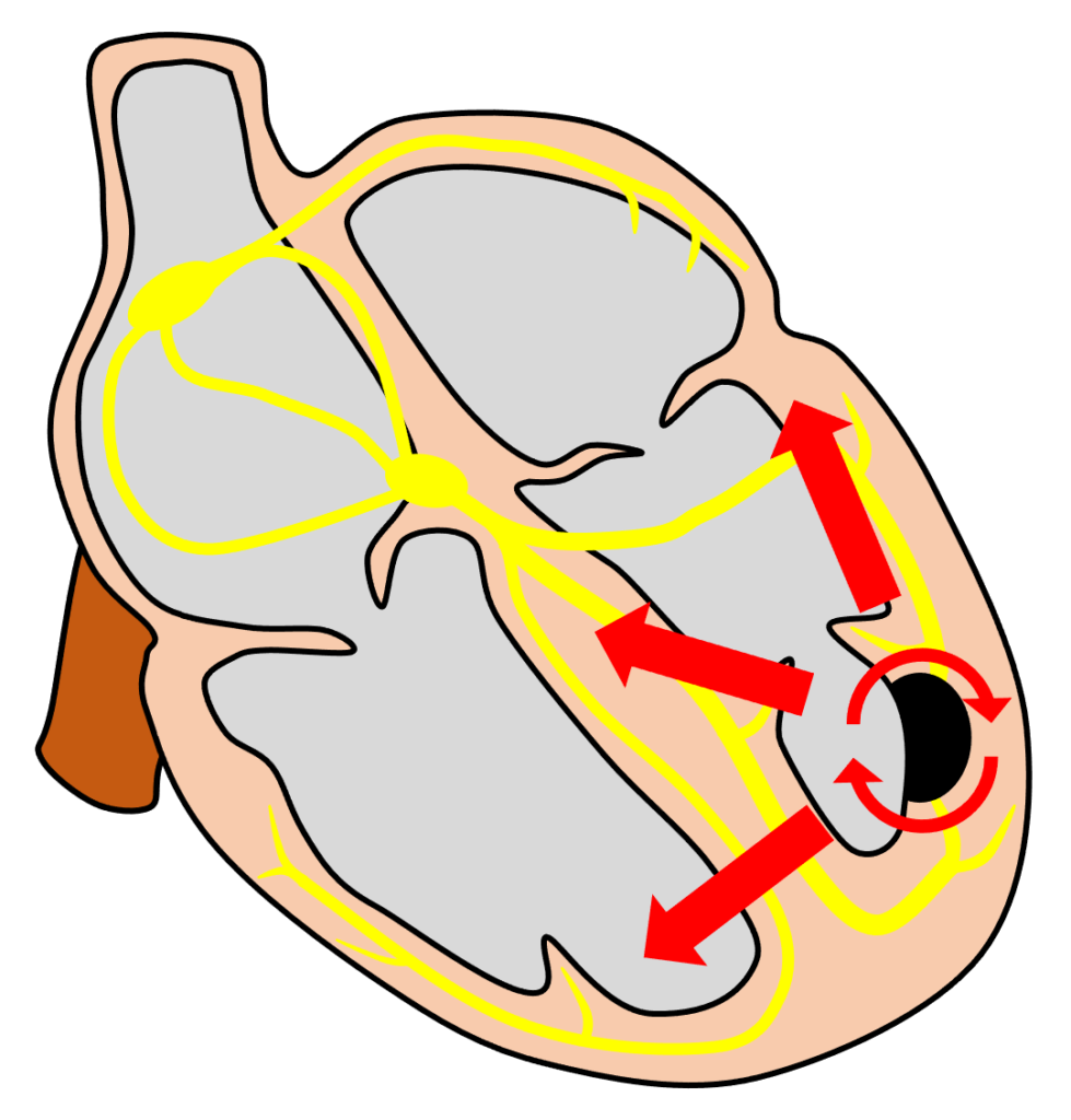 心室頻拍(Ventricular Tachycardia)