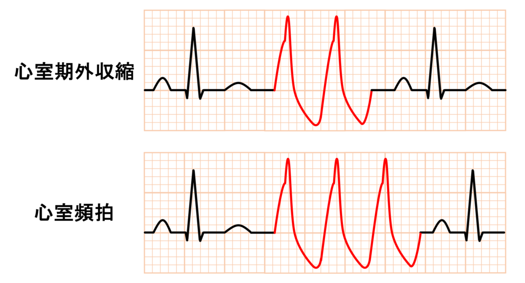 心室頻拍(Ventricular Tachycardia)