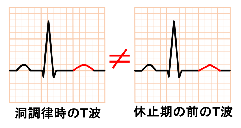 非伝導性心房期外収縮(blocked PAC)