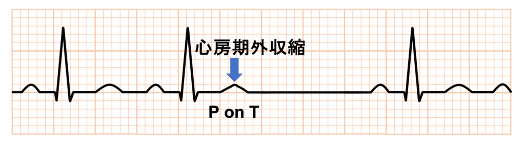 非伝導性心房期外収縮(blocked PAC)