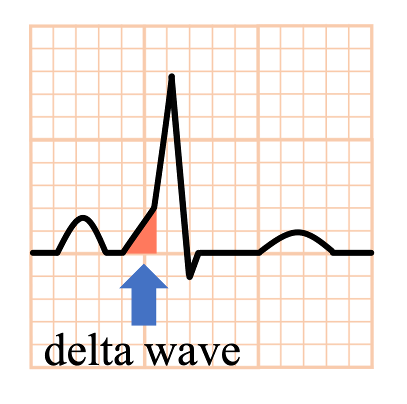 Δ波(delta wave)