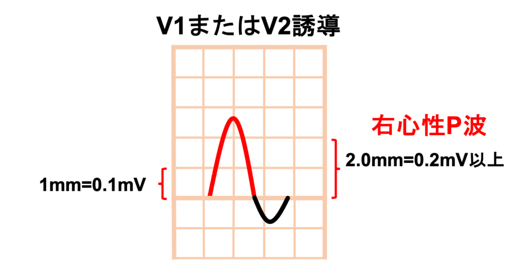 右心性P波(P dextrocardiale)