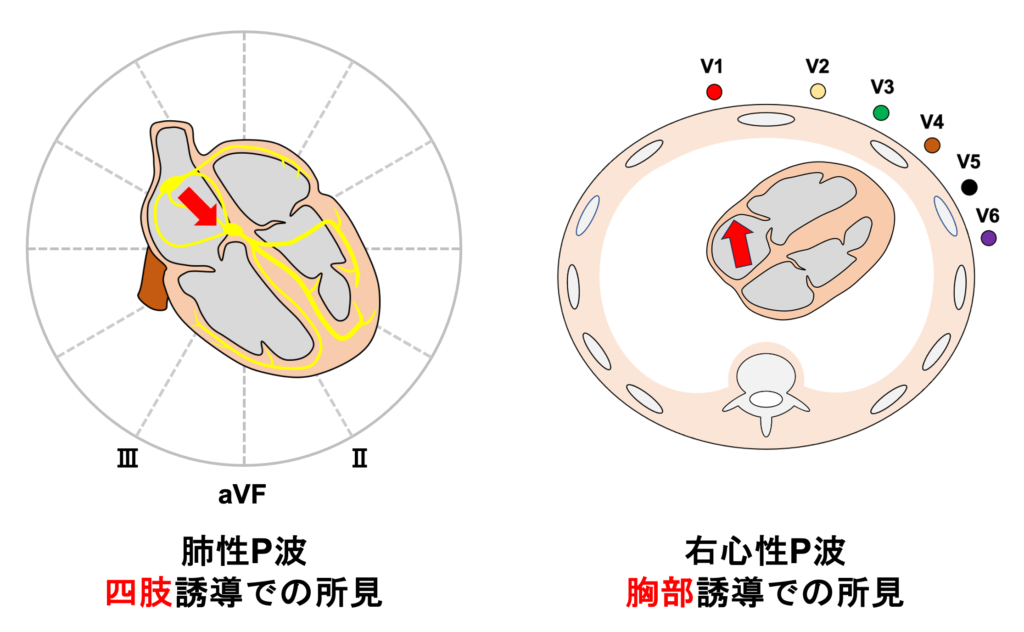 右心性P波(P dextrocardiale)