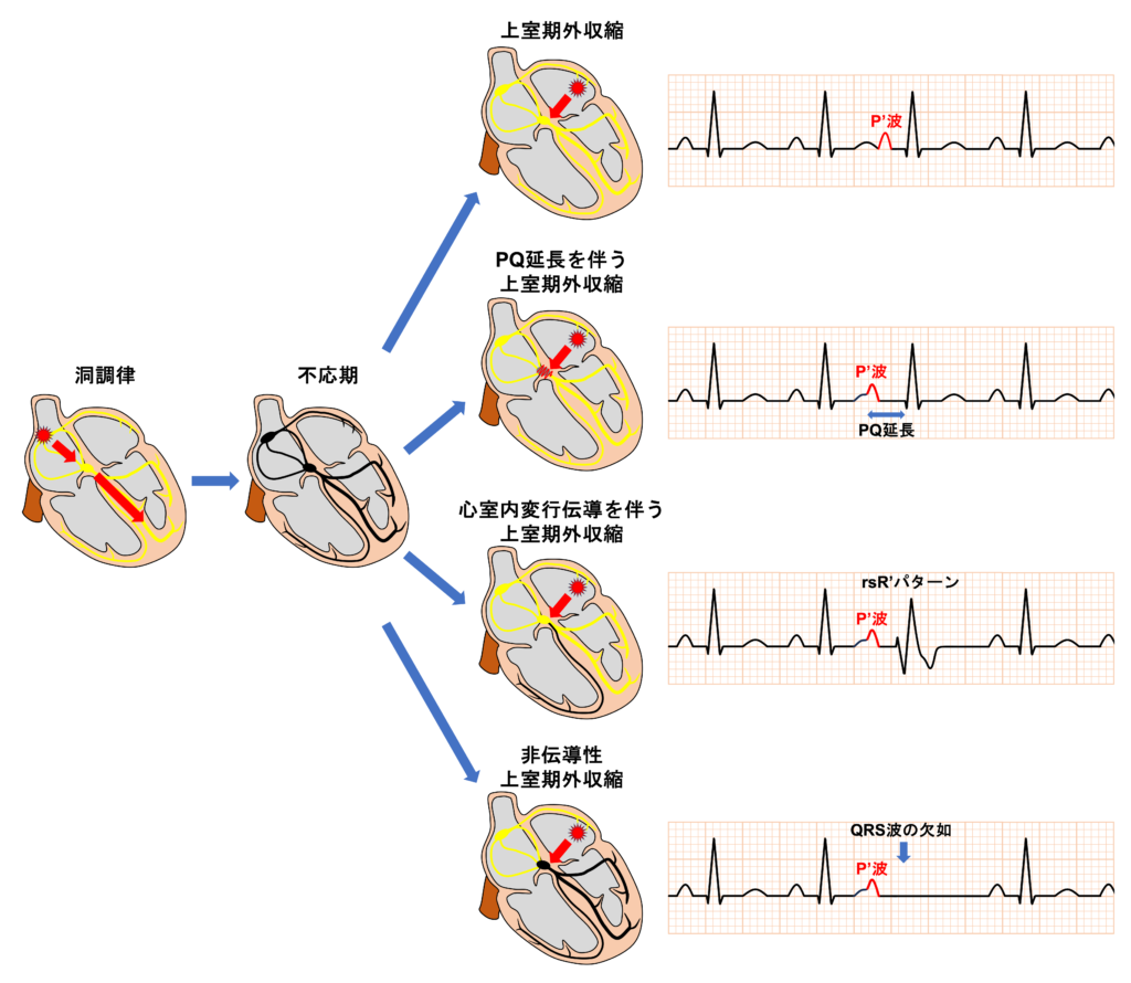 上室期外収縮(Supraventricular premature contraction：SVC)