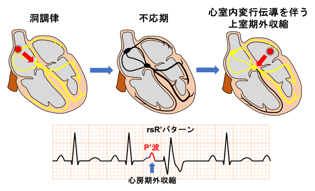 上室期外収縮(Supraventricular premature contraction：SVC)