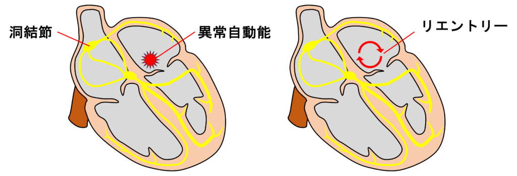 心房頻拍(atrial tachycardia)