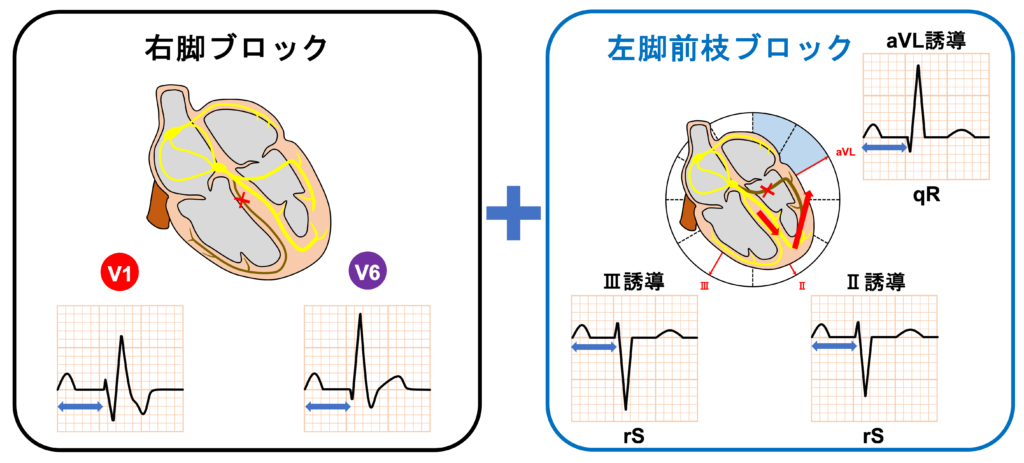 ３枝ブロック(trifascicular block)