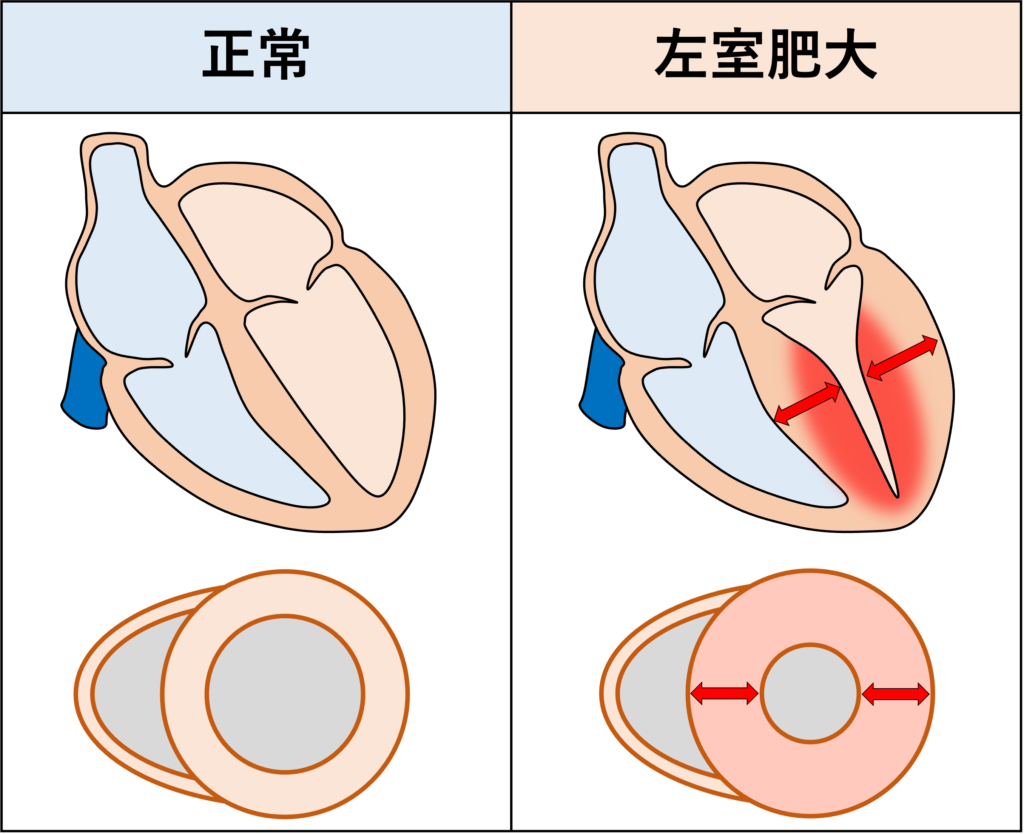 左室肥大(left ventricular hypertrophy)