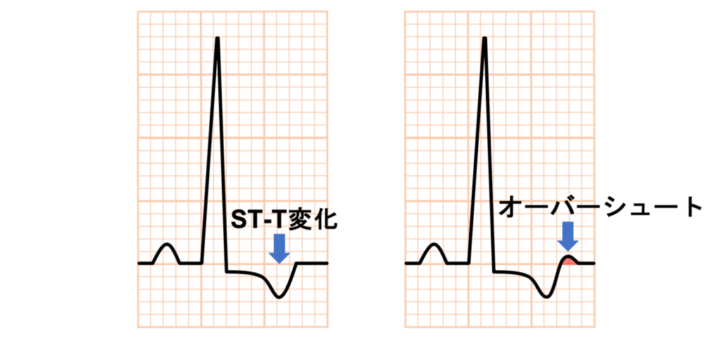左室肥大(left ventricular hypertrophy)