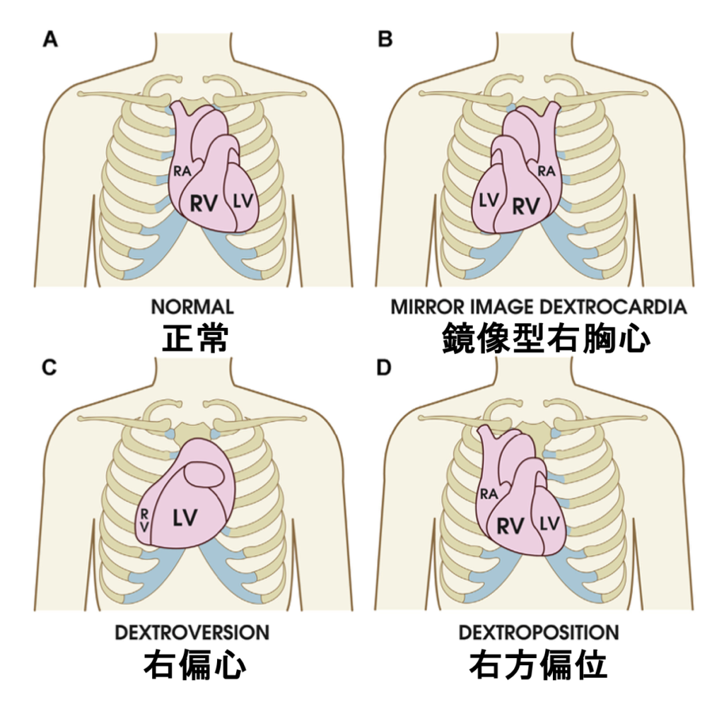 右胸心(dextrocardia)
偏位の仕方によっても以下のように名称がついています