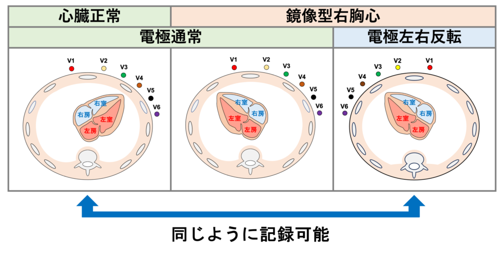 右胸心(dextrocardia)