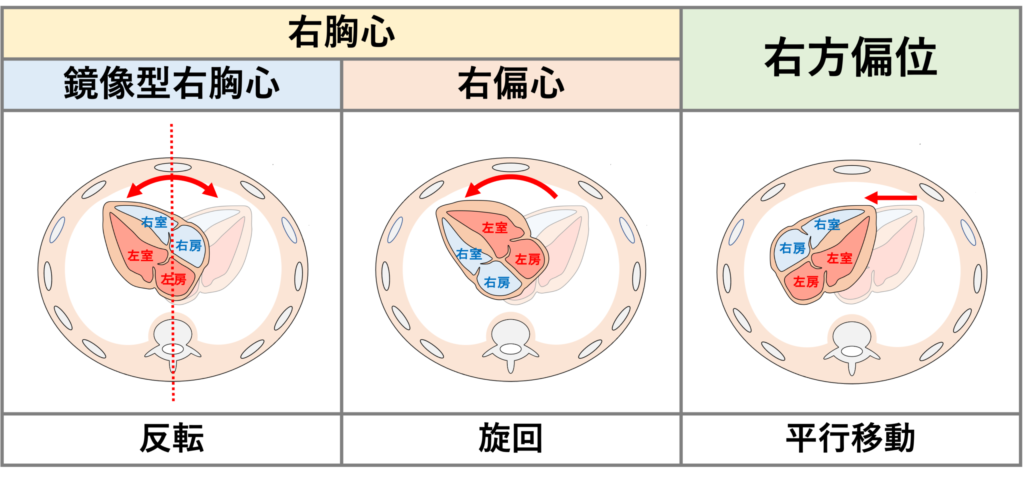 右胸心(dextrocardia)
鏡像型右胸心は先天性心疾患ですが、右偏心は先天性と後天性の両方が存在します。右方偏位も先天性と後天性があり、後天的には右肺切除後などで心臓が右側に偏位することで生じます。右方偏位に関しては、心臓は右胸腔にありますが心尖部は左を向いているので右胸心の定義には当てはまりません。