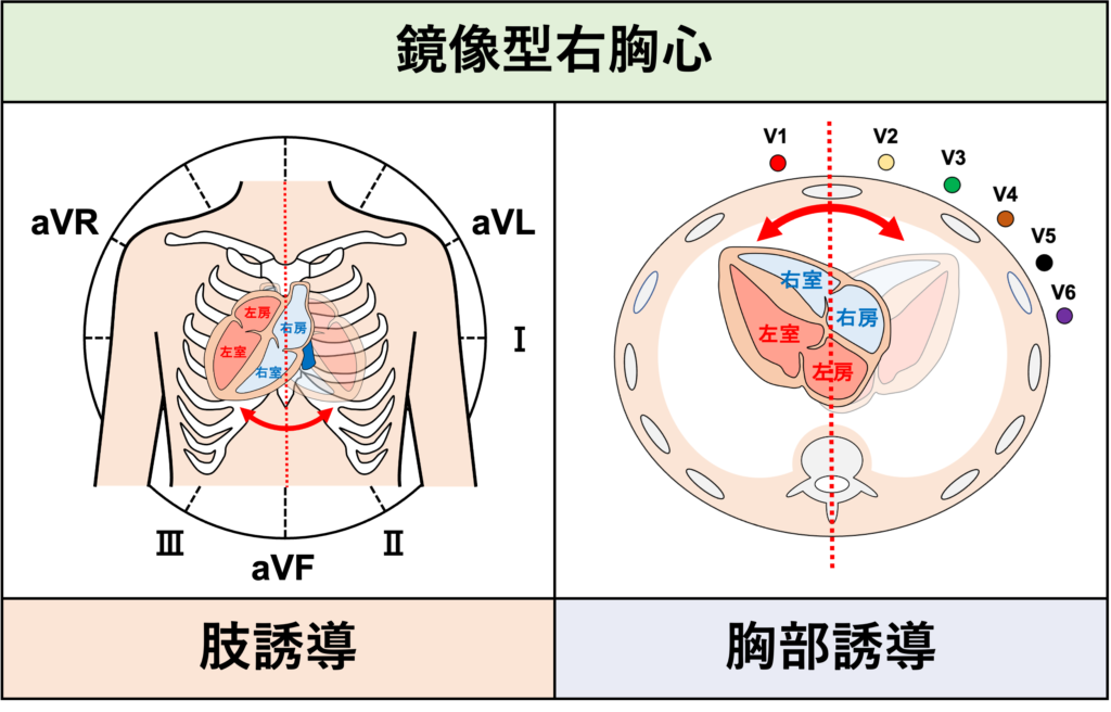 右胸心(dextrocardia)