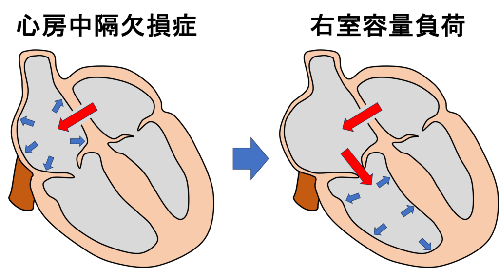 右室容量負荷(right ventricular volume overload)