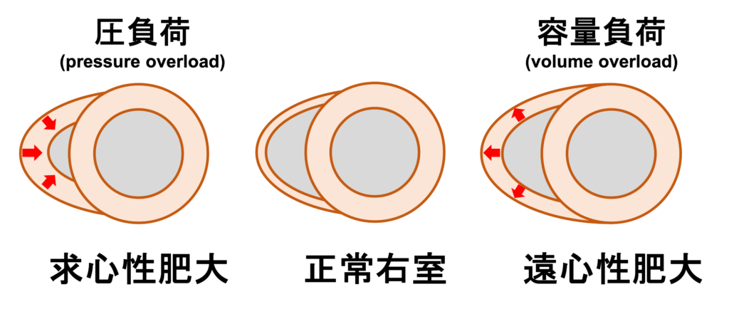 右室容量負荷(right ventricular volume overload)