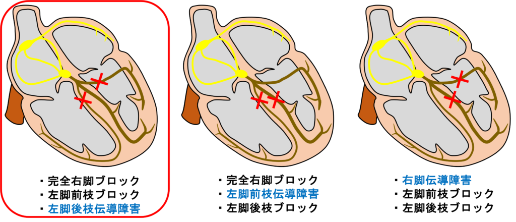 ３枝ブロック(trifascicular block)