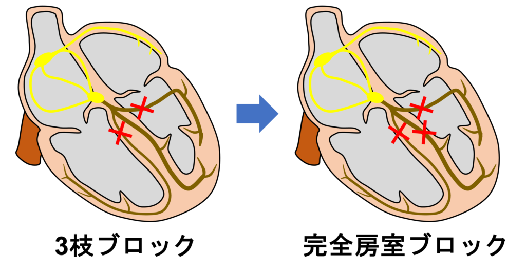 ３枝ブロック(trifascicular block)