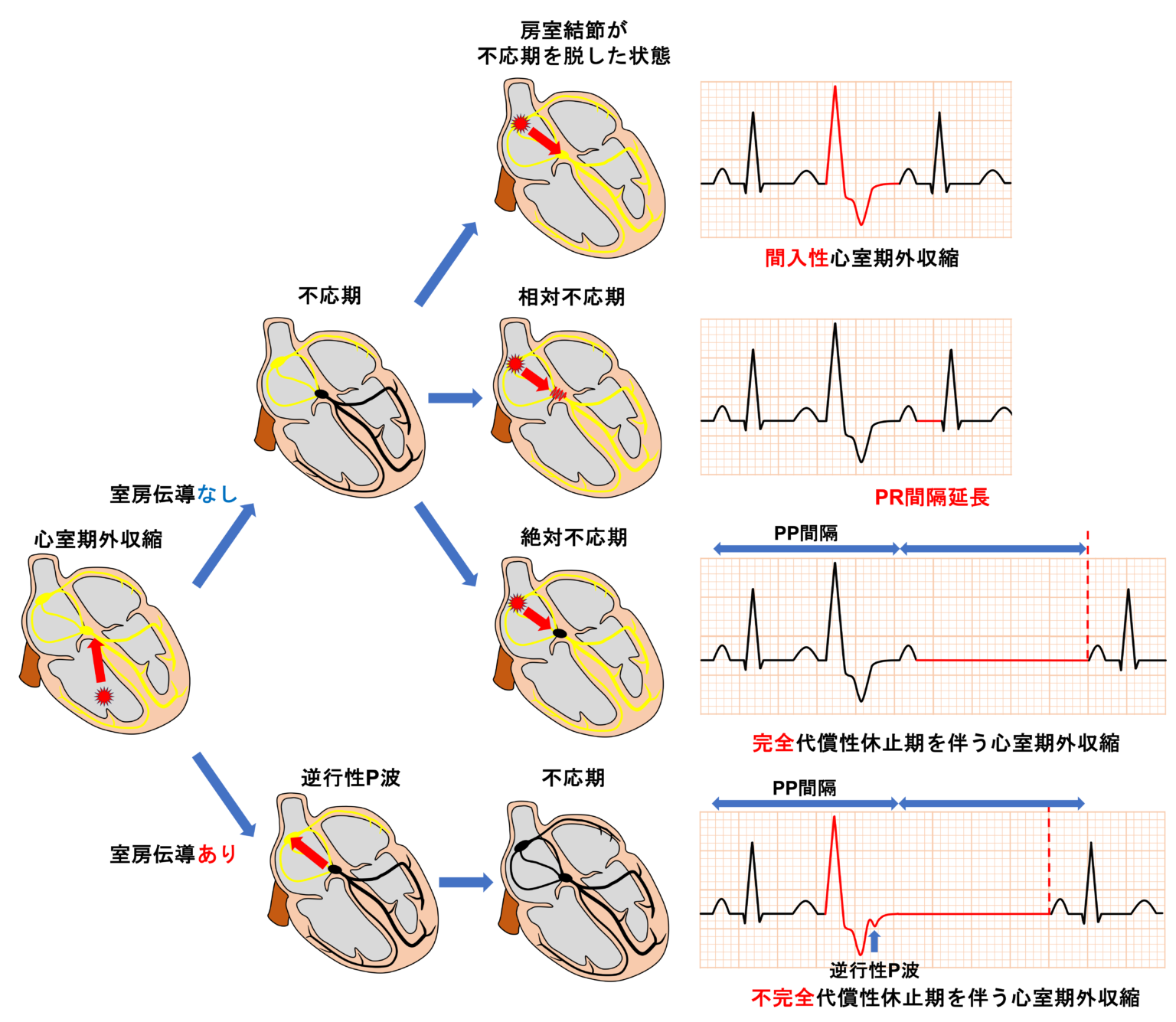心室期外収縮とは？ | 心電図.com