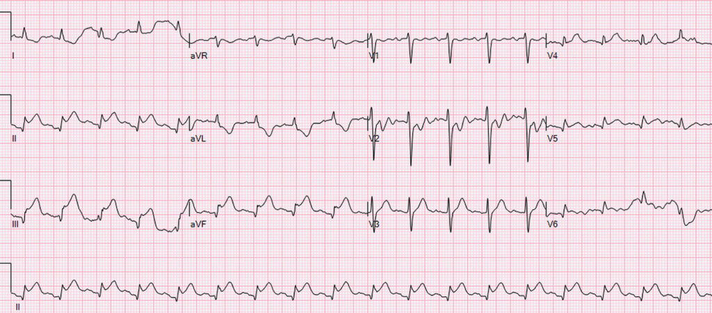 下壁心筋梗塞(inferior myocardial infarction)