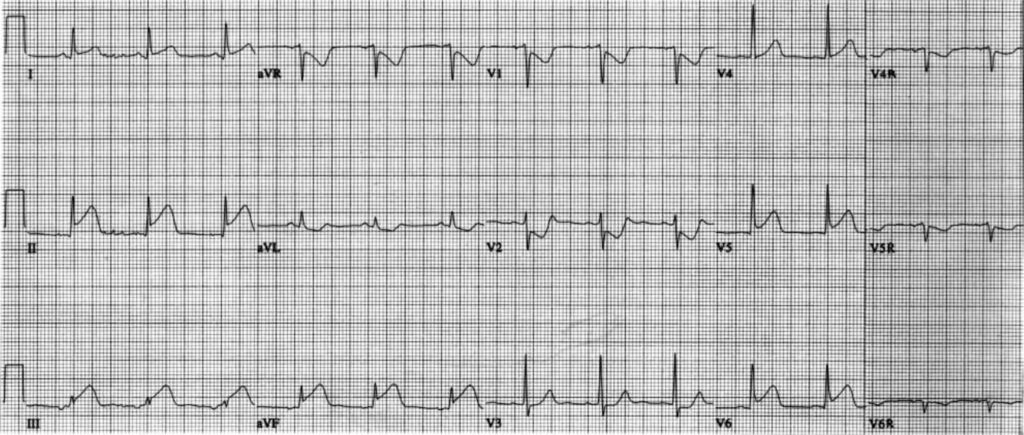 下壁心筋梗塞(inferior myocardial infarction)