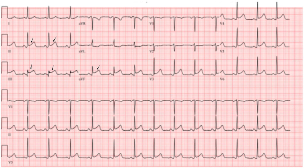 下壁心筋梗塞(inferior myocardial infarction)