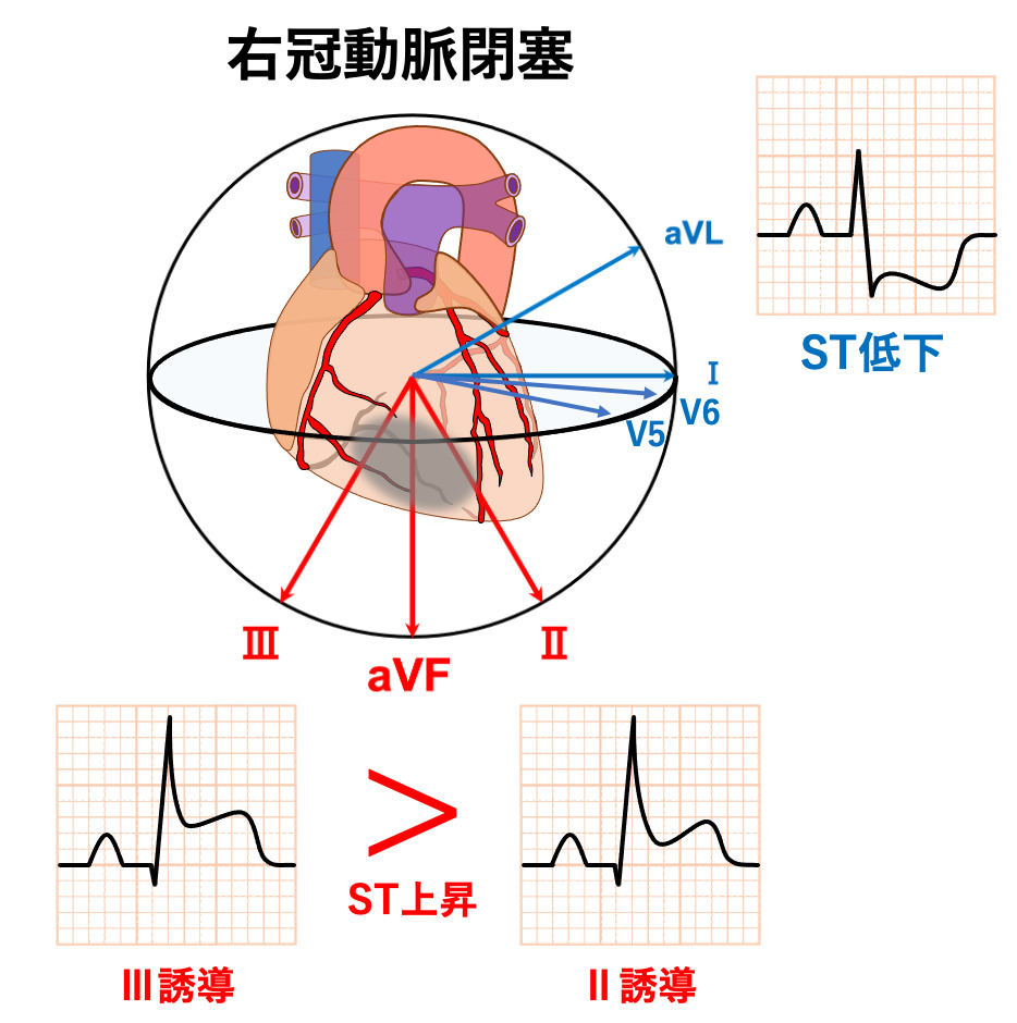 下壁心筋梗塞(inferior myocardial infarction)