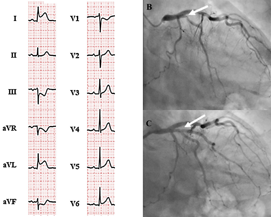 側壁心筋梗塞(lateral myocardial infarction)