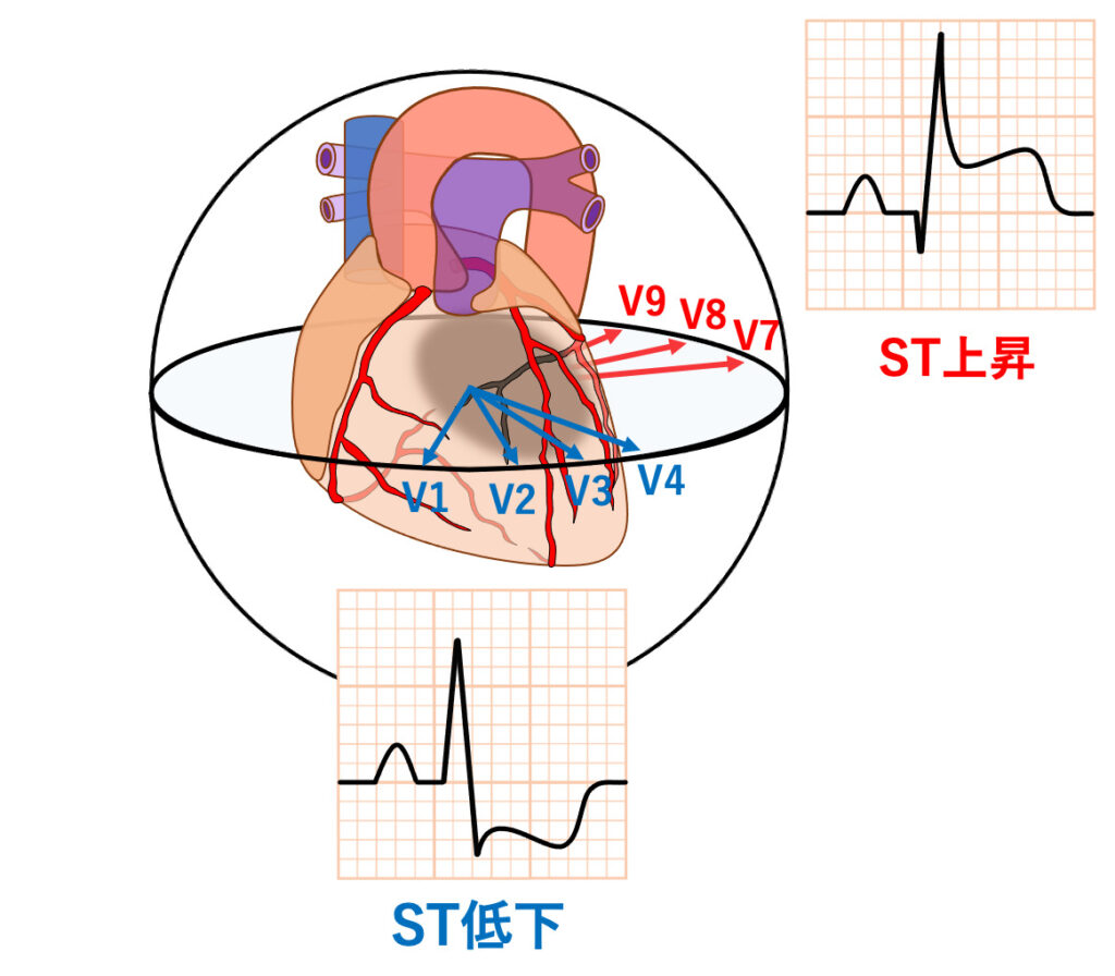 後壁心筋梗塞(posterior myocardial infarction)