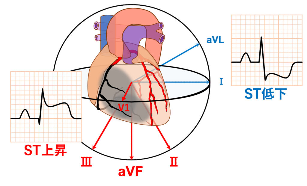 右室梗塞(right ventricular infarction)