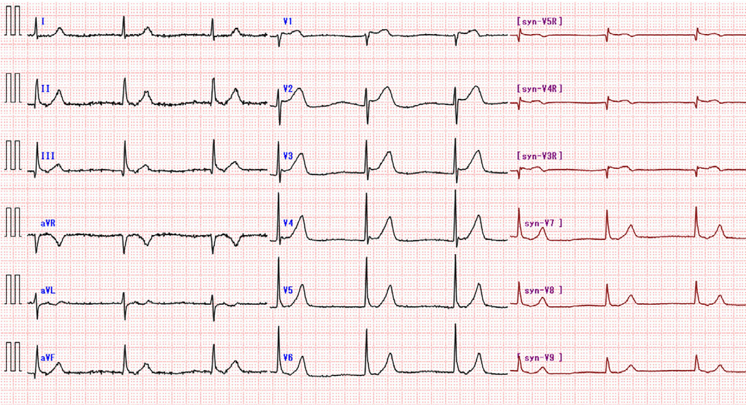 孤立性右室梗塞(isolated right ventricular infarction)