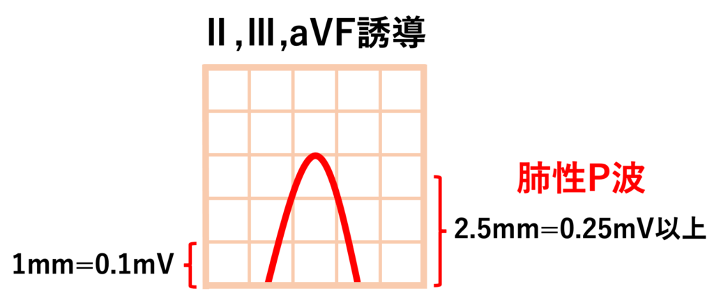 肺性P波(P pulmonale)