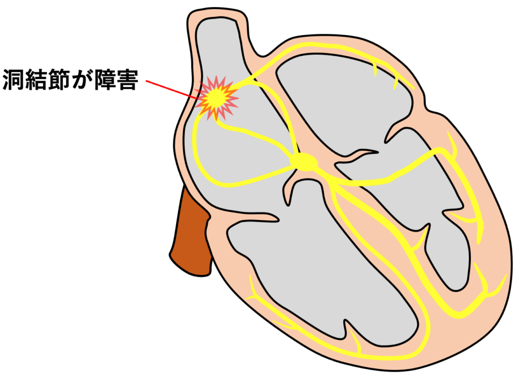 洞停止(sinus arrest)