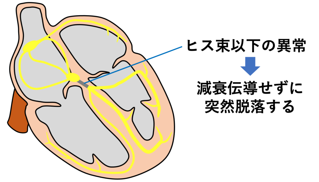 MobitzⅡ型Ⅱ度房室ブロック(Mobitz typeⅡ second degree atrioventricular block)