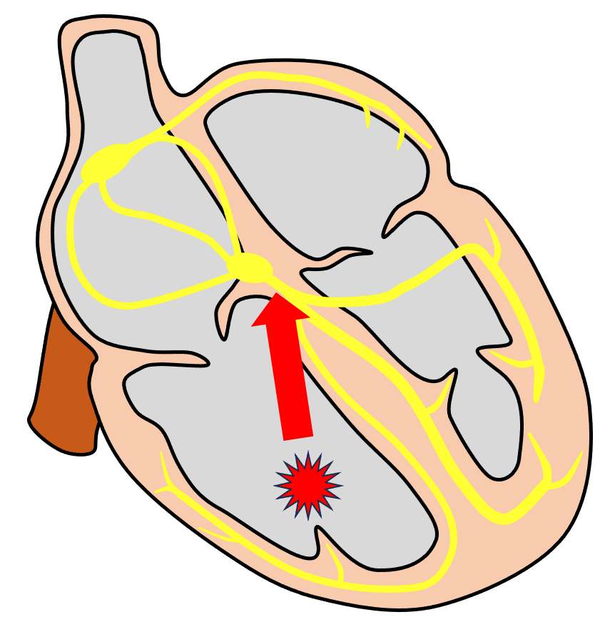 心室期外収縮(Premature Venticular Contraction：PVC)