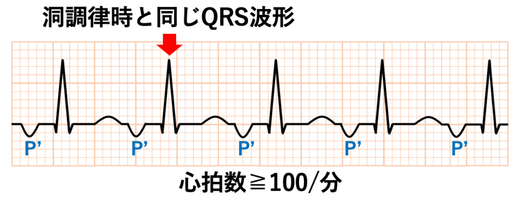 心房頻拍(atrial tachycardia)