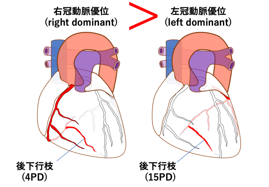 下壁心筋梗塞(inferior myocardial infarction)