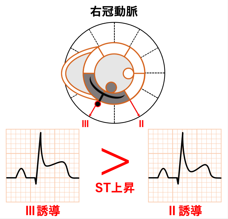 下壁心筋梗塞(inferior myocardial infarction)