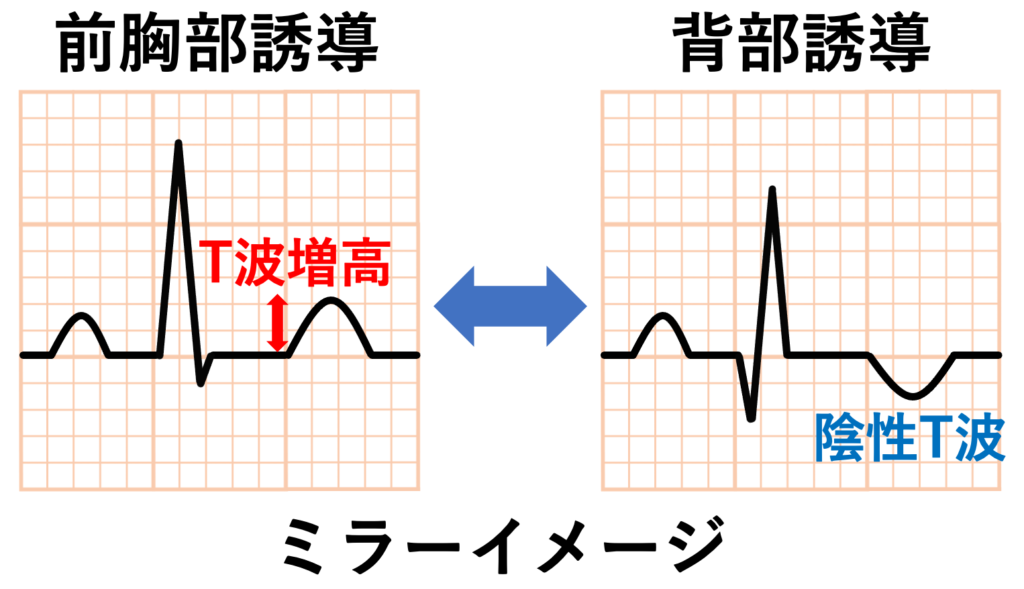 後壁心筋梗塞(posterior myocardial infarction)