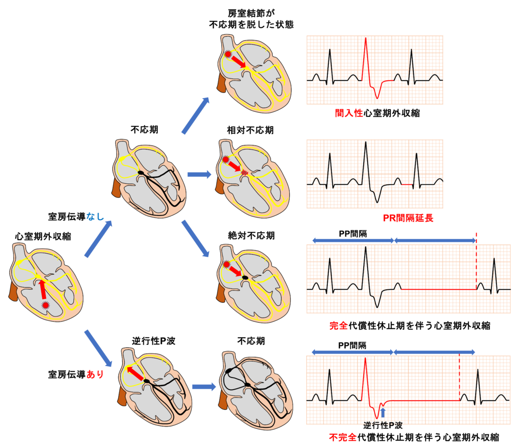 心室期外収縮(Premature Venticular Contraction：PVC)