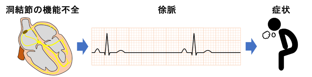 洞不全症候群(sick sinus syndrome)