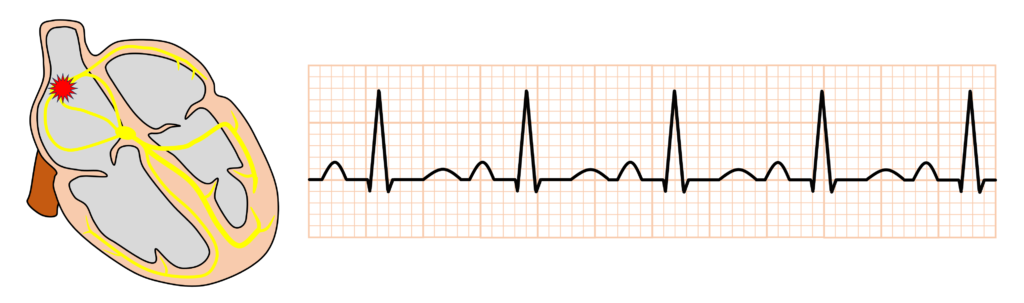 洞性頻脈(Sinus tachycardia)