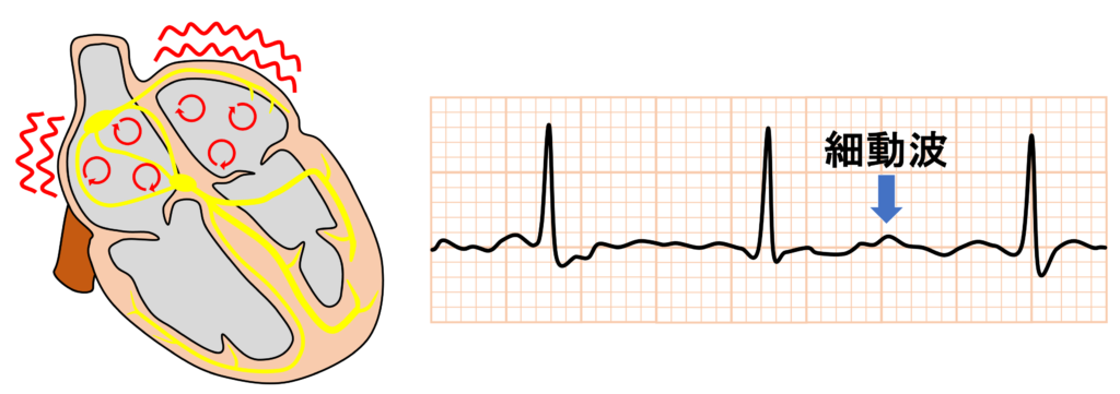 心房細動(Atrial fibrillation)